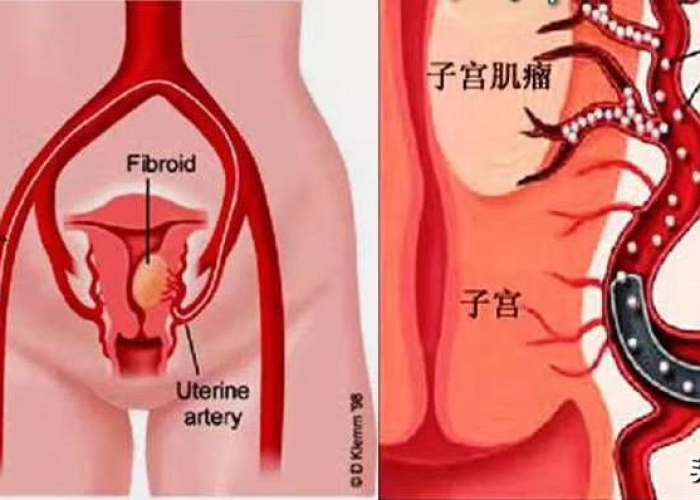 疫情指的是什么病毒类型，疫情具体是什么病